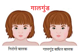 गालगुंड (Mumps)