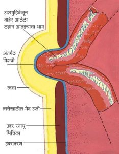 अंतर्गळ (Hernia)