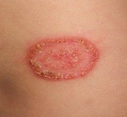 Read more about the article नायटा (Ringworm)