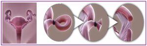 Read more about the article स्त्री नसबंदी शस्त्रक्रिया (Female contraception)