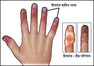 Read more about the article हिमदंश (Frostbite)