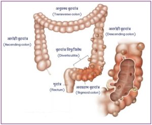 बृहदांत्र विपुटीविकार आणि विपुटीशोथ (Diverticulosis & Diverticulitis)