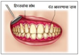 Read more about the article विन्सेंट संसर्ग (Vincent’s infection)