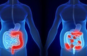 प्रदाहक आंत्ररोग (Inflammatory bowel diseases, IBD)