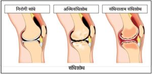 संधिशोथ (Arthritis)