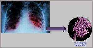 Read more about the article क्षयरोग (Tuberculosis)