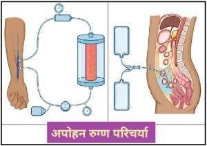 Read more about the article अपोहन रुग्ण परिचर्या (Dialysis Patient Nursing)